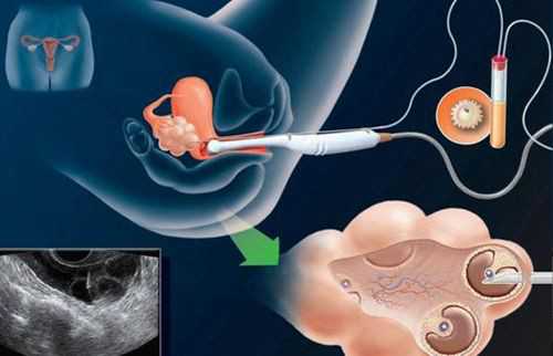三代试管代孕公司_试管婴儿包生女孩,
              囊胚移植后一口气吃了三根香